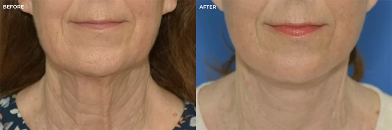 Female face, before and after facelift surgeon, front view (patient 1)