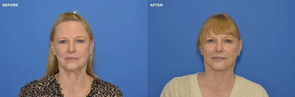 Female face, before and after facelift surgeon, front view (patient 2)