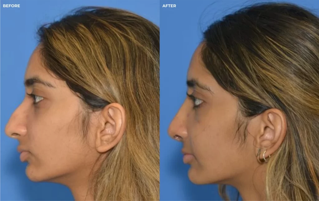 Female face, before and after Revision Rhinoplasty treatment, side view - patient 2