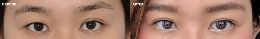 Female eyes, before and after Asian blepharoplasty, front view - patient 1