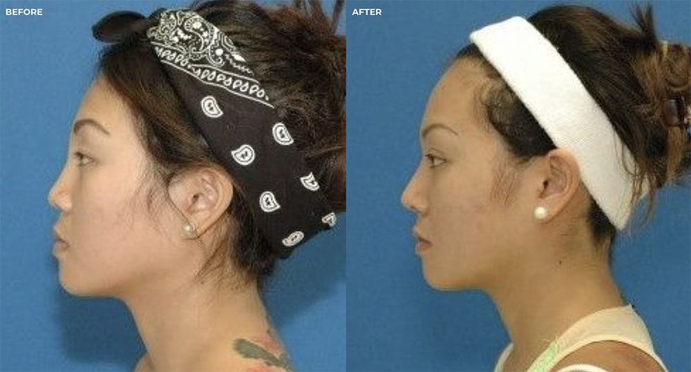 Procedure: Asian Rhinoplasty