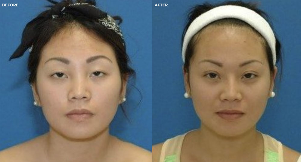 Procedure: Asian Rhinoplasty