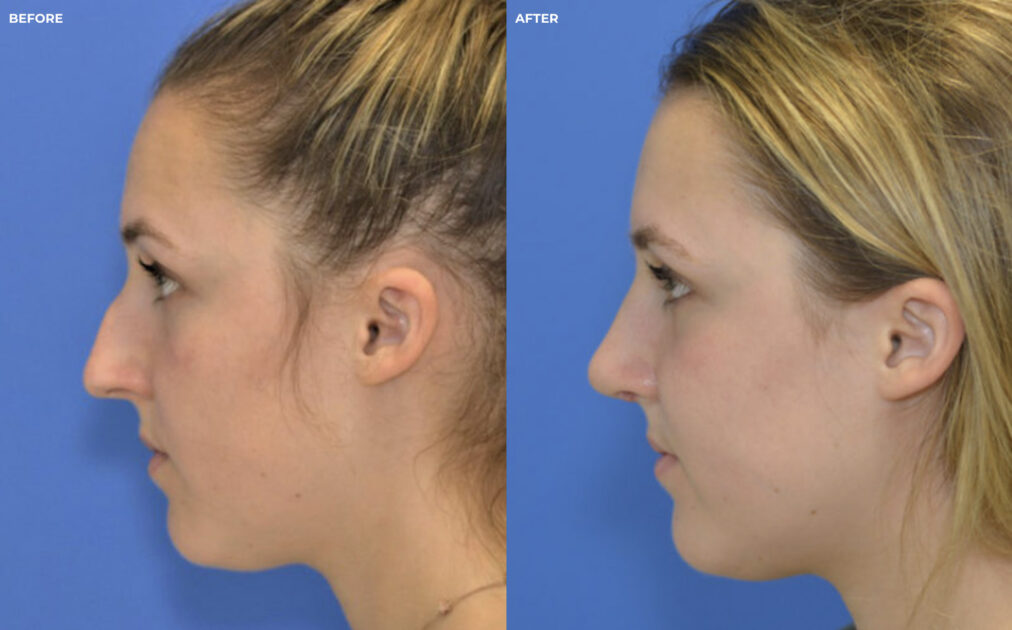 Female face, before and after Revision Rhinoplasty treatment, side view - patient 1