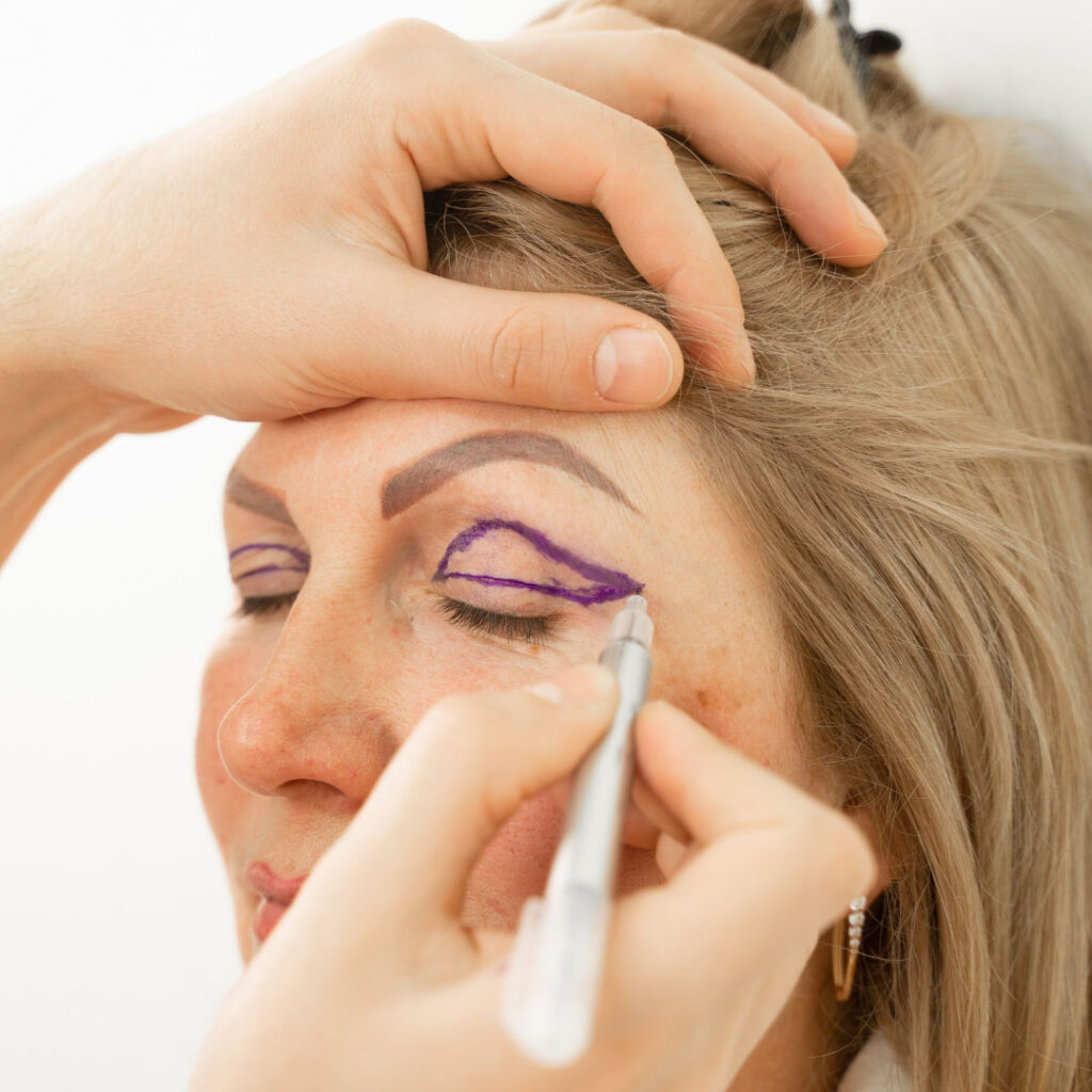 Upper Eyelid Markings for Blepharoplasty Surgery on Female Patient